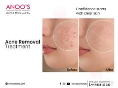 Advanced Acne Removal Treatment at Anoos